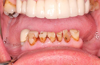 picture of mouth before all-on-4 procedure
