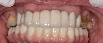 image of mouth after all-on-4 procedure
