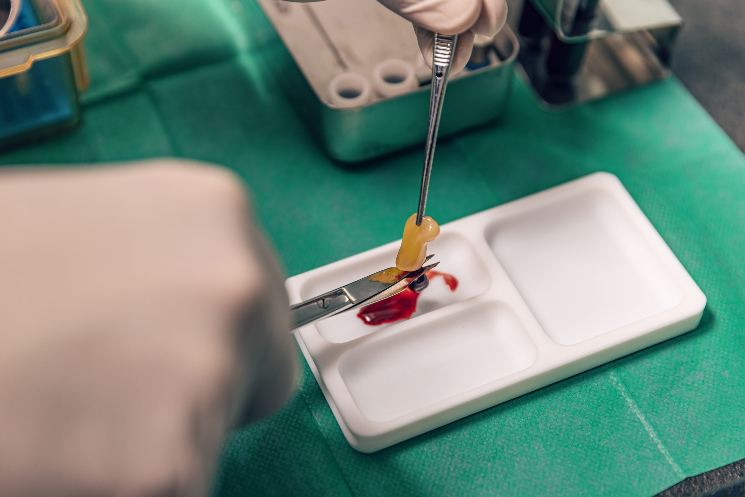 Platelet-rich fibrin (PRF) therapy preparation in a dental implant clinic, highlighting advanced techniques used for enhancing healing and supporting dental implant procedures.