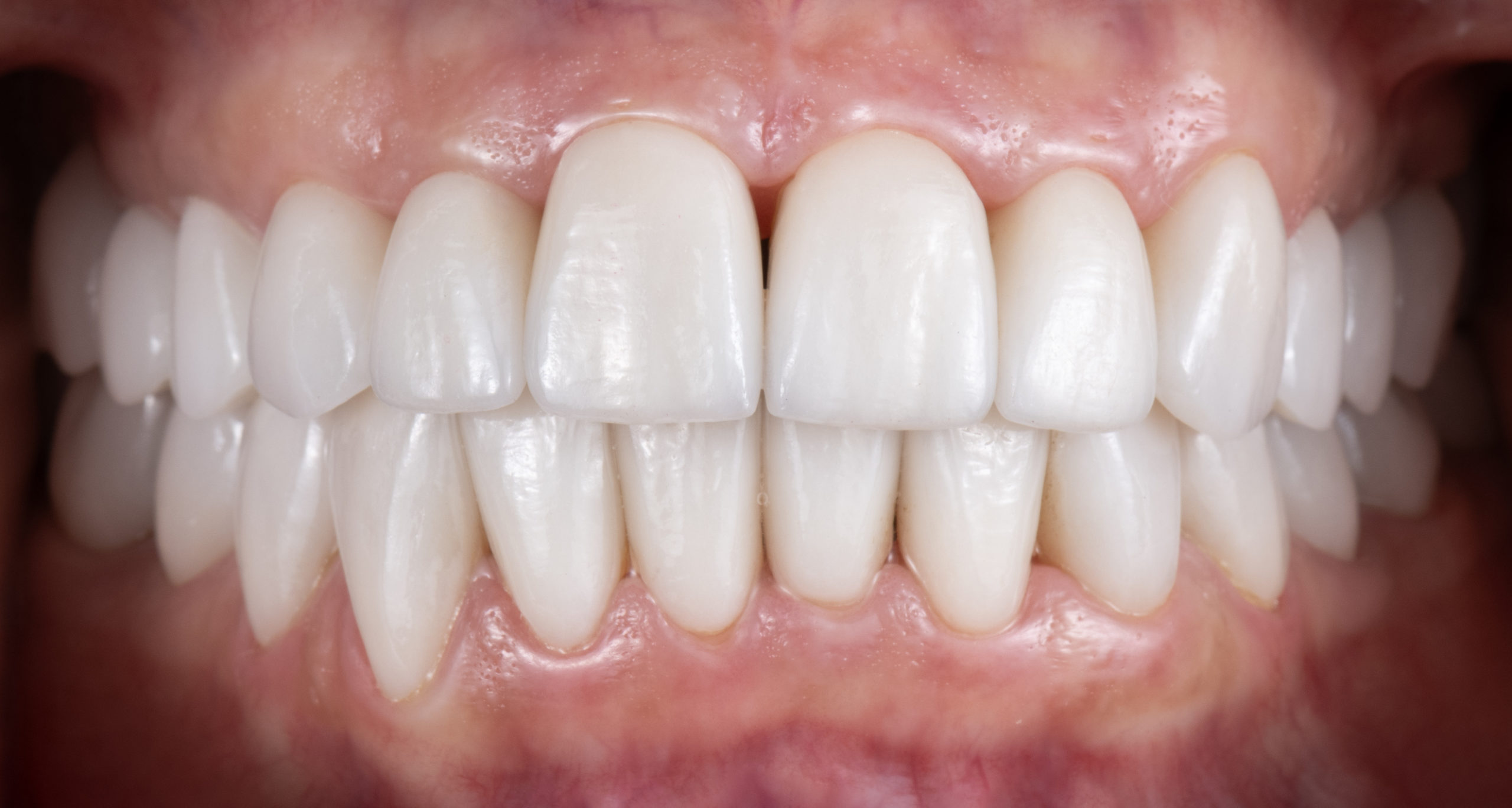 Close-up of ceramic crowns and veneers displayed in a dental implant office, showcasing highquality materials used for restorative and cosmetic dental implant treatments.